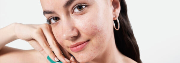 Pieles con tendencia acneica